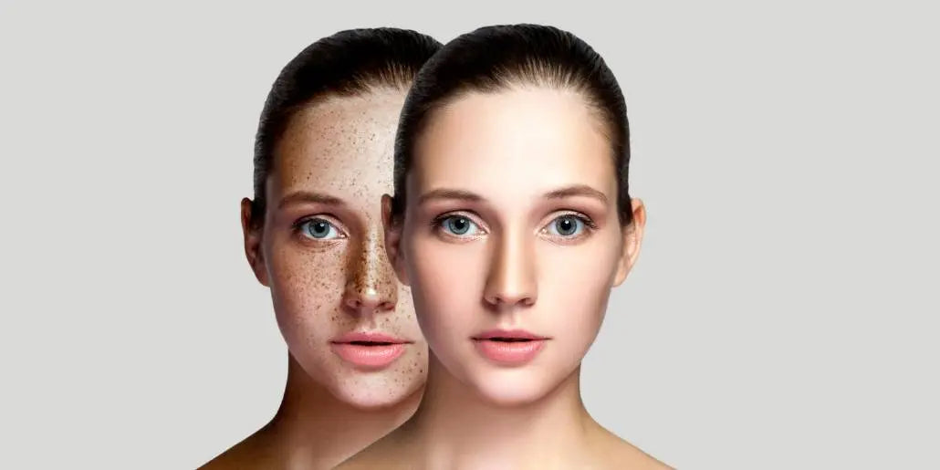 How do I Get Rid of Pigmentation on My Face?